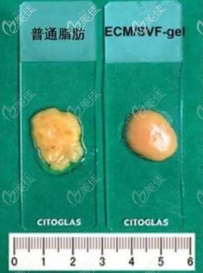 普通脂肪与脂肪胶的区别 普通脂肪与脂肪胶的区别