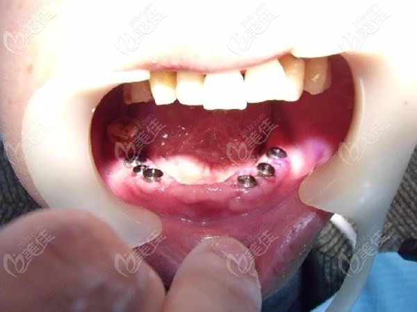 70岁老人下半口牙齿缺失<span style= 70岁老人下半口牙齿缺失<span style=