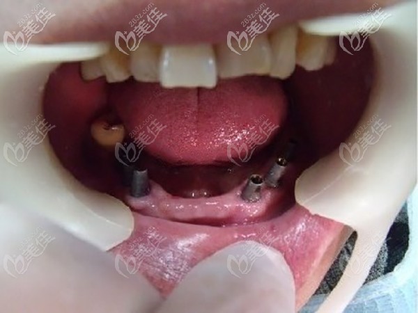 allon6吧半口种植体 allon6吧半口种植体