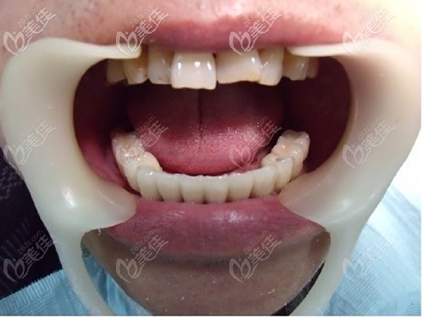 七十岁老人下半口牙缺失在昆明柏德做6颗进口种植体修复，看看效果
