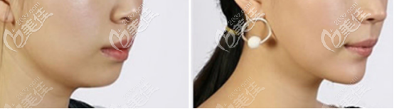 晟假体垫下巴的效果图