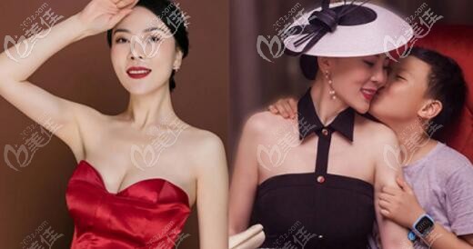 做完娜绮丽假体隆胸后的效果 做完娜绮丽假体隆胸后的效果