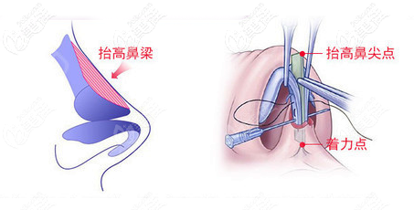 邹进进隆鼻优势 邹进进隆鼻优势