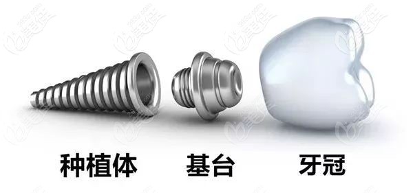 泰安康盛亲水种植体