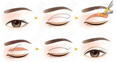 切开双眼皮手术过程示意图 切开双眼皮手术过程示意图