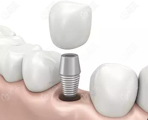 黄志斌医生擅长的种植牙技术 黄志斌医生擅长的种植牙技术