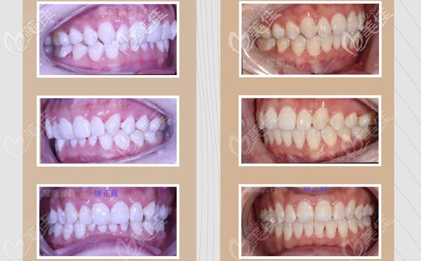 深覆颌矫正的前后效果图 深覆颌矫正的前后效果图