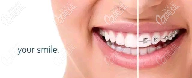 牙齿矫正中微笑曲线的保留更美观