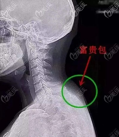 富贵包的形成原因