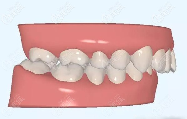 关于牙齿深覆颌的危害 关于牙齿深覆颌的危害
