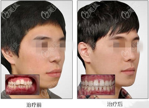 无托槽隐形矫正牙齿需要多少钱?这位龅牙顾客做的隐适美隐形矫正的价格三万多!