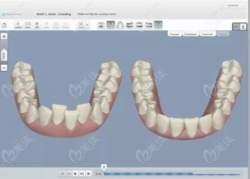 建立顾客的牙齿3D模型