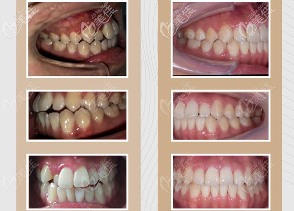 嗨,杭州雅莱齿科的牙齿正畸案例更新了!含有深覆颌矫正的效果图哦