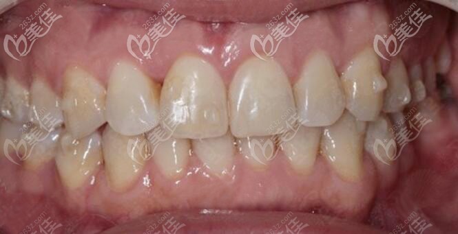 两颗下门牙往里凹在东莞牙易美带上时代天使牙套后，同事们都没人看出来