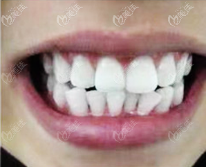 做隐适美牙齿矫正术前照片 做隐适美牙齿矫正术前照片