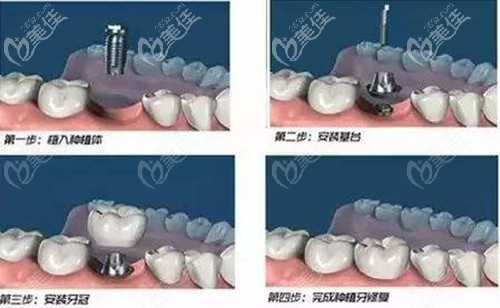 微创种植牙过程