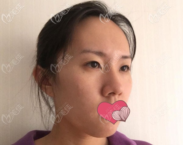 硅胶鼻第7天拆线，肿胀已经拆线