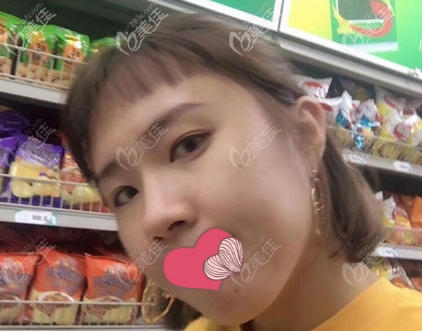 假体隆鼻一个月已经定型