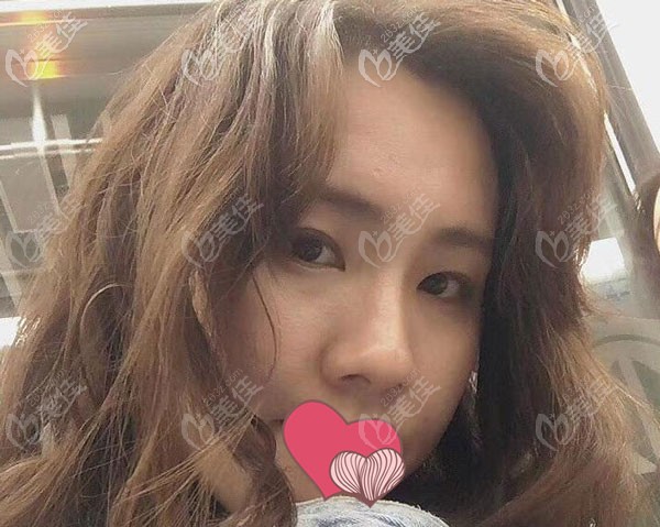 硅胶假体隆鼻2个月，鼻梁看起来更柔和了