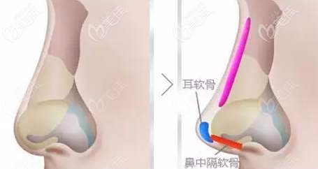 樊国友院长隆鼻手术风格 樊国友院长隆鼻手术风格