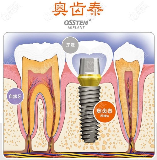 韩国奥齿泰种植系统