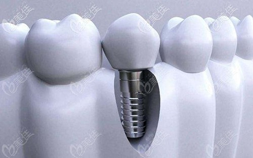 种植牙和真牙很相似