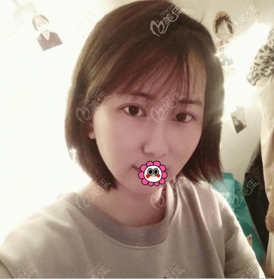 在北京蒂凡妮医疗美容做面部吸脂有7天了 在北京蒂凡妮医疗美容做面部吸脂有7天了