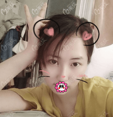 做面部抽脂半个多月样子 做面部抽脂半个多月样子