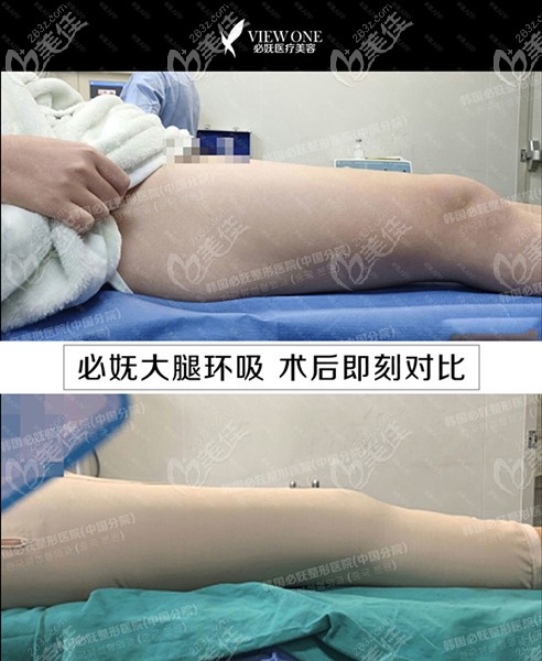 贵阳必妩做大腿环吸手术案例
