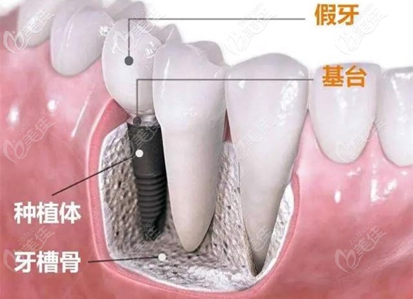 种半口种植牙是什么感觉呢