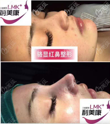 贵州利美康鼻综合案例 贵州利美康鼻综合案例