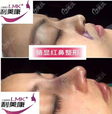 骆显红医生驼峰鼻矫正案例 骆显红医生驼峰鼻矫正案例