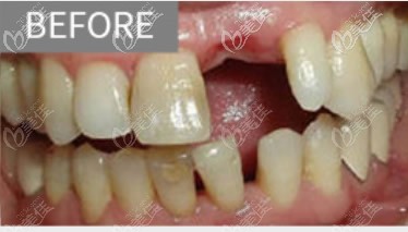 深圳博爱曙光口腔种植牙前 深圳博爱曙光口腔种植牙前