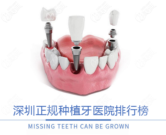 深圳正规种植牙医院排行榜来啦,都是种牙技术靠谱的医院哦