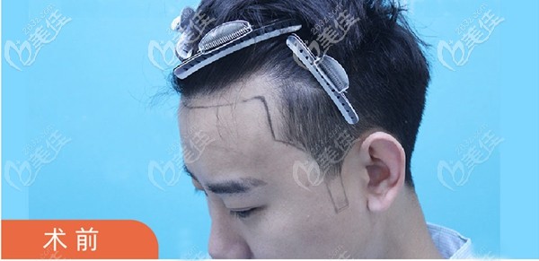 发际线种植前的方案设计图 发际线种植前的方案设计图