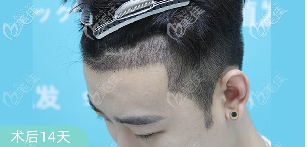 种植发际线毁了我一生?这样的男士种植发际线效果图片我宁愿让“毁”我一生!