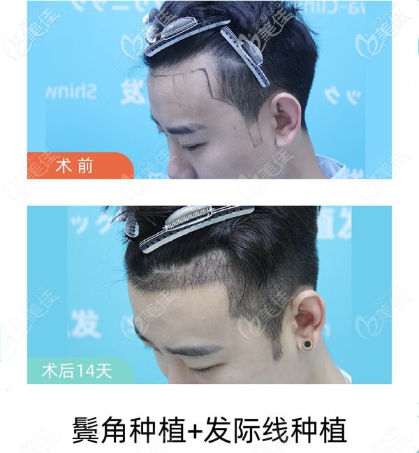男士种植发际线效果图片 男士种植发际线效果图片