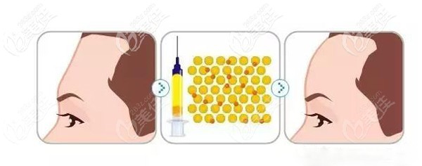 采用自体脂肪填充术后效果