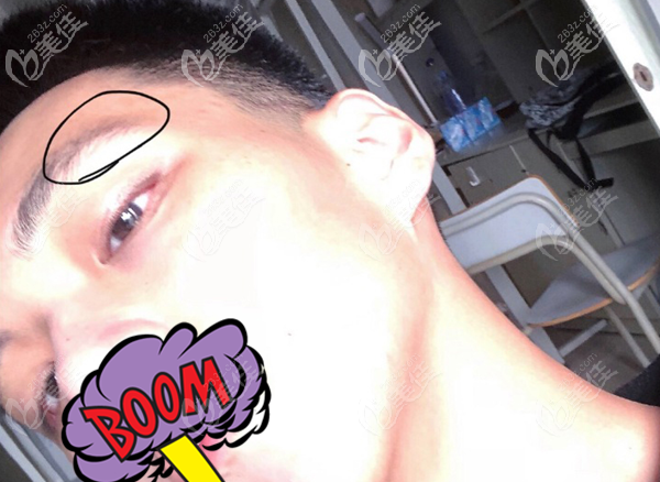 眉毛种植之前的效果图 眉毛种植之前的效果图