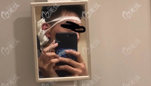 眉毛种植术后即刻效果 眉毛种植术后即刻效果