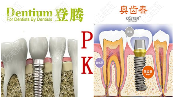韩国登腾与奥齿泰优劣对比 韩国登腾与奥齿泰优劣对比