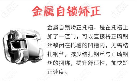 唐山牙博士口腔金属自锁托槽