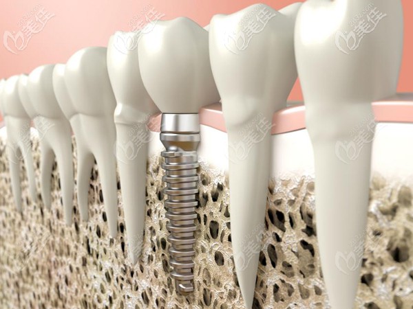 韩国仕诺康和奥齿泰哪个好