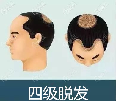 4级地中海脱发面积 4级地中海脱发面积