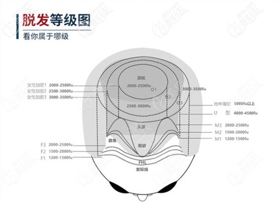 脱发等级图及需要种植的毛囊单位数量 脱发等级图及需要种植的毛囊单位数量