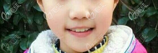 10岁儿童上牙前突到福州松鼠做mrc早期牙齿矫正后笑容更自信