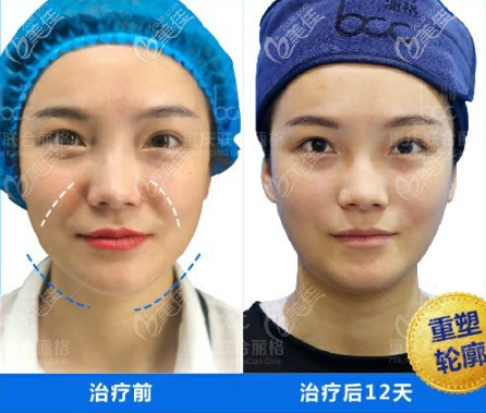 面部轮廓重塑案例