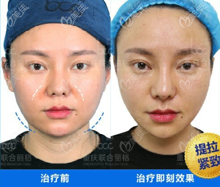 重庆联合丽格面部提升案例