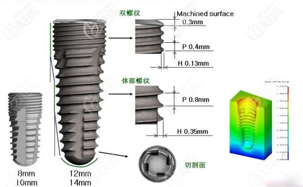 韩国迪奥DIO种植体介绍