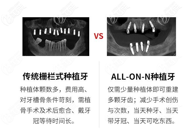 allon4种植技术和传统种植技术区别